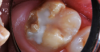 A distolingual cusp was destroyed by caries.