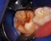 A 7-year-old presented with a malformed, sensitive molar.