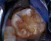 The tooth was prepared for a restoration with an RMGI bioactive ionic resin-based composite.