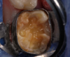 An orthodontic matrix band was placed and a self-etching bonding agent was applied.