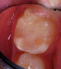 Occlusal view