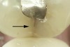 Fig 2. Asymptomatic enamel marginal ridge crack (arrow) of a mandibular left second molar with enamel ditching viewed under magnification by intraoral photography (mesio-occlusal view).