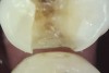 Fig 8. Complete removal of caries and crack elimination by fissurotomy in tooth shown in Fig 7.