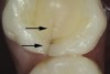 Fig 10. Stained asymptomatic enamel marginal ridge crack (arrows) of a maxillary right first molar extending to the existing restoration (mesio-occlusal view).