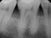 2. Fig 2. Periapical radiograph showing presence of distal bone loss and calculus.