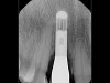 Fig 6. Periapical radiograph indicates proximal bone loss only.