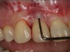 Fig 7. Probing of the buccal surface reveals additional loss of attachment around the dental implant.