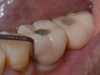 Fig 9. Deep probing around dental implant in the absence of BoP does not indicate ongoing peri-implant disease.