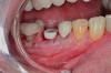 Fig 1. Immediate implant placement with a PEEK healing abutment to contour soft tissue, mandibular right first molar.