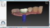 Fig 7. Open STL system design software for screw-retained crown.