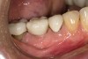 Fig 14. Screw-retained implant crown replacing missing first molar, occlusal view (Fig 13) and buccal view (Fig 14).