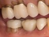 Fig 15. Final restoration of mandibular right first molar.