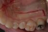 Fig 1. To begin harvesting a FGG, a rectangle of tissue is outlined using a #15C scalpel; rugae are smoothed from the graft prior to removing it.