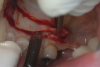 Fig 2. The FGG is undermined by making an incision into the connective tissue layer, leaving the epithelial layer intact.