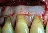 Fig 5. The graft was placed on the roots to the level of the presurgical FGM and completely replacing the native tissue (marginal graft placement).