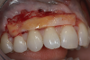 Fig 11. After a split-thickness flap had been elevated, with the primary flap displaced apically leaving connective tissue on the bone and providing access for root preparation, a CTG was harvested from the palate and placed over the roots.