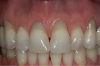 Fig 13. Preoperative retracted view showing extent of recession in a patient with composite restorations that had been placed to cover exposed roots and noncarious cervical lesions.