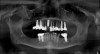 Fig 2. Preoperative radiograph revealing the failing implant at No. 13 that would be explanted; then the site would be curetted and a new, wider-diameter implant placed.