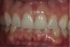 Fig 3. At 5 months, gingival health is indicated by the absence of inflammation and plaque. Smooth, dull facial surface of incisors is indicative of mild acid erosion.