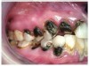 Fig 7 through Fig 9. This young patient’s only prosthetic option was extraction of all remaining teeth and subsequent placement of complete dentures.