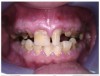 Fig 4 through Fig 6. Patient’s oral condition after 6 years of meth use.