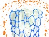 Fig 1 and Fig 2. Delmopinol hydrochloride interferes with biofilm matrix formation (Fig 1). The biofilm mass becomes loosely adherent and can be easily removed by the patient Fig 2. (Images courtesy of Sunstar Americas, Inc. Used with permission.)