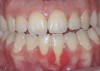 CASE 2 Fig 4. Post-orthodontic Miller Class II recession for which orthodontic treatment was not recommended. Clinical view 3 years after orthodontic treatment, showing relapse in teeth alignment and GR on lower left central incisor.