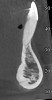 Fig 5. CBCT sagittal view of the same patient showing thin/no bone on the lingual aspect.