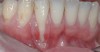 CASE 3 Fig 6. Post-orthodontic Miller Class II recession recommended for orthodontic treatment. Clinical view 5 years after orthodontic treatment showing a buccally displaced root of the lower incisor.