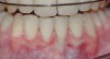 CASE 4 Fig 9. Post-orthodontic Miller Class II recession treated with surgical coverage only in spite of the incorrect inclination of the affected tooth. Clinical view immediately post-orthodontic treatment.