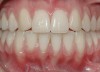 CASE 5 Fig 12. Post-orthodontic Miller Class I recession of lower left central incisor 9 months after completion of first orthodontic treatment.