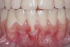 CASE 6 Fig 14. Post-orthodontic Miller Class II recession treated with a combined orthodontic-surgical approach. Clinical view 5 years after first orthodontic treatment showing GR of right lower incisor and a labially prominent root.