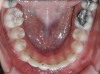 Fig 16. Occlusal view of patient shows the difference in angulation between the affected and the adjacent incisors.