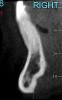 Fig 18. CBCT sagittal view shows no bone on the labial aspect and 2.5 mm bone thickness on the lingual aspect.