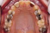 Fig 3. Maxillary occlusal view of worn dentition through erosion.