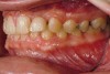 Fig 4. Left lateral view of patient with worn dentition. Note loss of vertical dimension in posterior as evidenced by the buccal cusp tip position of tooth No. 12 versus the papillary tissue of teeth Nos. 20 and 21.