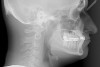 Fig 5. Preoperative cephalometric view highlighting maxillary deficiency, brachycephalic craniofacial phenotype, short upper face height, and maxillary retrognathia. Thin facial bone and proclined incisors are also noted.