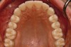 Fig 13. Prosthetic phase completion. Maxillary occlusal view. Note arch form change without compromise to the buccal alveolar bone and periodontal phenotype.