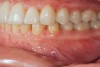 Fig 14.  Prosthetic phase completion. Left lateral view. Note vertical dimension change in posterior as evidenced by the buccal cusp tip position of tooth No. 12 versus papillary tissue of teeth Nos. 20 and 21 as compared to initial presentation (Fig 4).