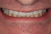 Fig 15. Smile dynamics. Maxillary hypoplasia and vertical maxillary deficiency with short upper lip but normal lip mobility remain. Patient declined orthognathic surgery to correct dentofacial disharmony.