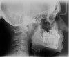 Fig 16. Postoperative cephalometric view. Note augmented facial bone in both arches. Buccal root torque/uprighting of the mandibular central incisor has been accomplished for improved inter-incisal angle position and improved iomechanics.