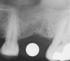 Figure 1  At tooth site No. 14, a periapical radiograph was taken with the long-cone paralleling technique. The radiographic ball marker measured 5.8 mm while its actual diameter is 5 mm. The enlargement is 0.8 mm, therefore the magnification error is 0.8/5 = 16%. By correcting for this error, a closer approximation of the amount of bone from the osseous crest to the sinus floor can be made.