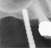 Figure 2  After drilling to a depth of 3 mm with a 2.1-mm twist drill, the guide pin was placed and a radiograph was taken to ascertain if the drill stopped within 1 mm of the subantral floor.
