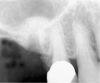 Figure 4  After infracturing the subantral wall with a 3.5-mm osteotome, bone was added and the presence of a dome was confirmed with a radiograph.