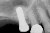 Figure 5  Insertion of a 4.8-mm implant, which fit snugly and increased the surface area for future osseointegration.