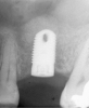 Figure 6  At site No. 14, a radiograph depicting the full 