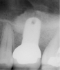 Figure 7  Radiograph depicting a 