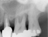 Figure 8  At site No. 13 the second bicuspid had a hopeless prognosis; it was to be extracted and replaced with an implant after a transcrestal sinus floor elevation.