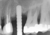 Figure 9: After the extraction, a 2.1-mm twist drill was used to drill within 1 mm of the subantral floor. A guide pin was placed and a radiograph was taken to ascertain if the drill stopped within 1 mm of the subantral floor.