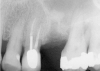 Figure 10  The osteotomy was completed with the 2.1-, 2.8-, and 3.5-mm twist drills without penetrating into the sinus. After infracturing the subantral wall with a 3.5-mm osteotome, bone was added and the presence of a dome was confirmed with a radiograph.